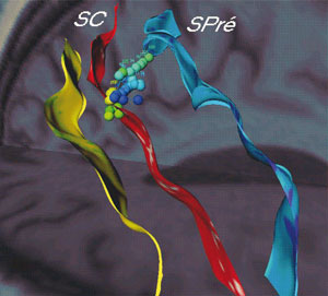 Figure 1: Volumetric representation of sulci from the central region with the representation of somatosensory activation acquired on MEG.