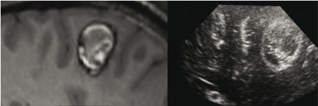 Figure 2: Registration of intraoperative ultrasound with pre-operative MRI.