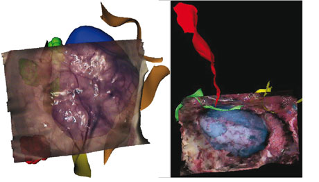 Figure 3: Surface based intraoperative reconstruction after dura opening (right) and tumor resection (left).