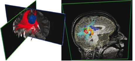 Figure 4: Combination of multimodal pre-surgical data outlining low grade lesions surrounded by fibers bundles (right: with fMRI markers as balls and sulci ribbons).