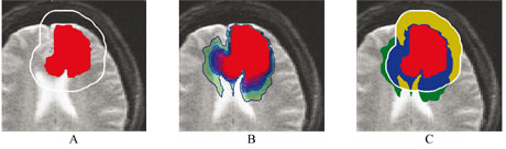 Figure 2. Application of the model to radiotherapy on a synthetic case. (A) Red: segmentation of the visible tumor in the image. White line: contour of the region targeted with radiotherapy. A constant margin of 1.5cm is used. (B) Estimated distribution of tumor cells computed with the model. The estimated distribution of tumor cells is highly inhomogeneous. (C) Blue: area invaded by the tumor and targeted by radiotherapy. Yellow: estimated healthy tissue targeted by radiotherapy. Green: invaded area of the brain that may be targeted by radiotherapy. The model could be used to adapt the targeted volume to apply the radiotherapy dose to the blue and green regions only.