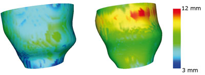 Figure 2: Left ventricle wall thickness plotted as an attribute of epicardial surface at end-diastole (left) and end-systole (right).