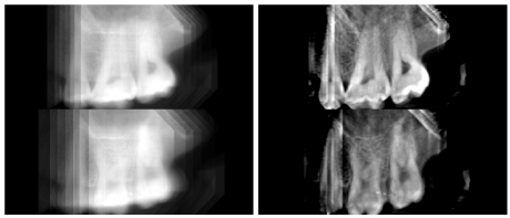 Figure 1: (left) Two slices of a traditional x-ray image reconstruction of teeth; (right) the corresponding slices of a reconstruction made with our statistical inversion methods from the same raw data.