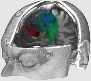 Overlay of a patient's tractography (a procedure to demonstrate the neural tracts) with anatomic magnetic resonance imaging. This allows a medical expert to better visualize and localise neuronal fibres. Modelling and visualizing brain function and pathophysiology is one of the exemplar projects proposed by the ERCIM Working Group Digital Patient. © INRIA/ASCLEIPOS.